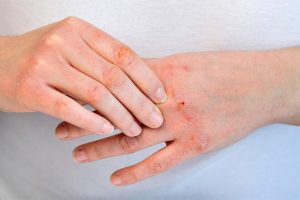 Bệnh viêm da cơ địa ở tay là gì? Nguyên nhân và dấu hiệu nhận biết