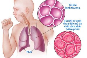 Viêm phổi có thể lây nhiễm không?