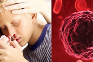 Bệnh ung thư máu là gì? Nguyên nhân và triệu chứng gây bệnh